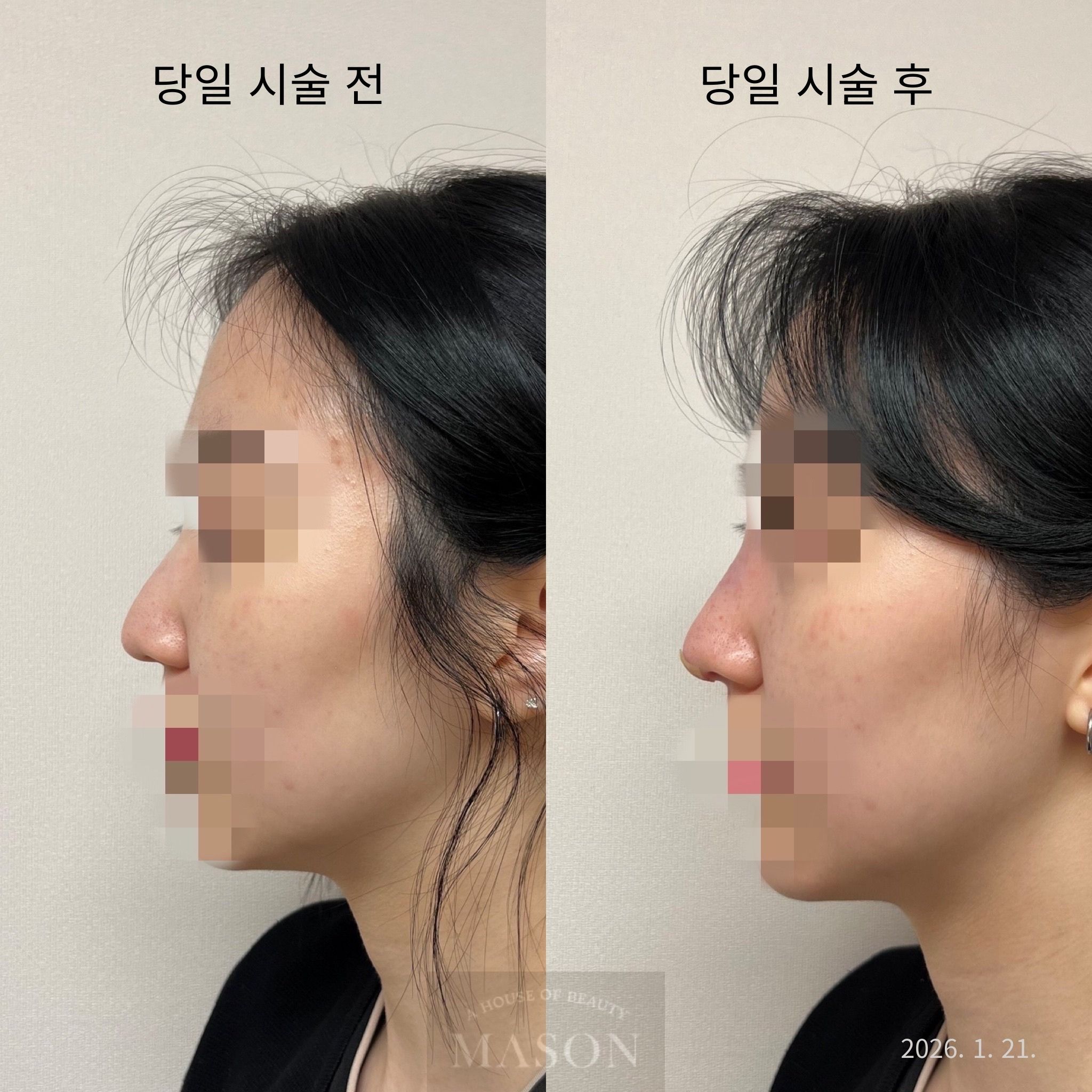 Nose thread lifting — bridge and tip at Mason Clinic. Mason Clinic, Seoul: Nose thread lifting — bridge and tip. Clinic-supplied comparison board. Same day