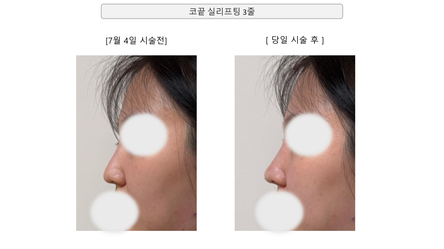 Nose-tip thread lifting — three threads at Mason Clinic. Mason Clinic, Seoul: Nose-tip thread lifting — three threads. Clinic document, page 12. Same day, July 4