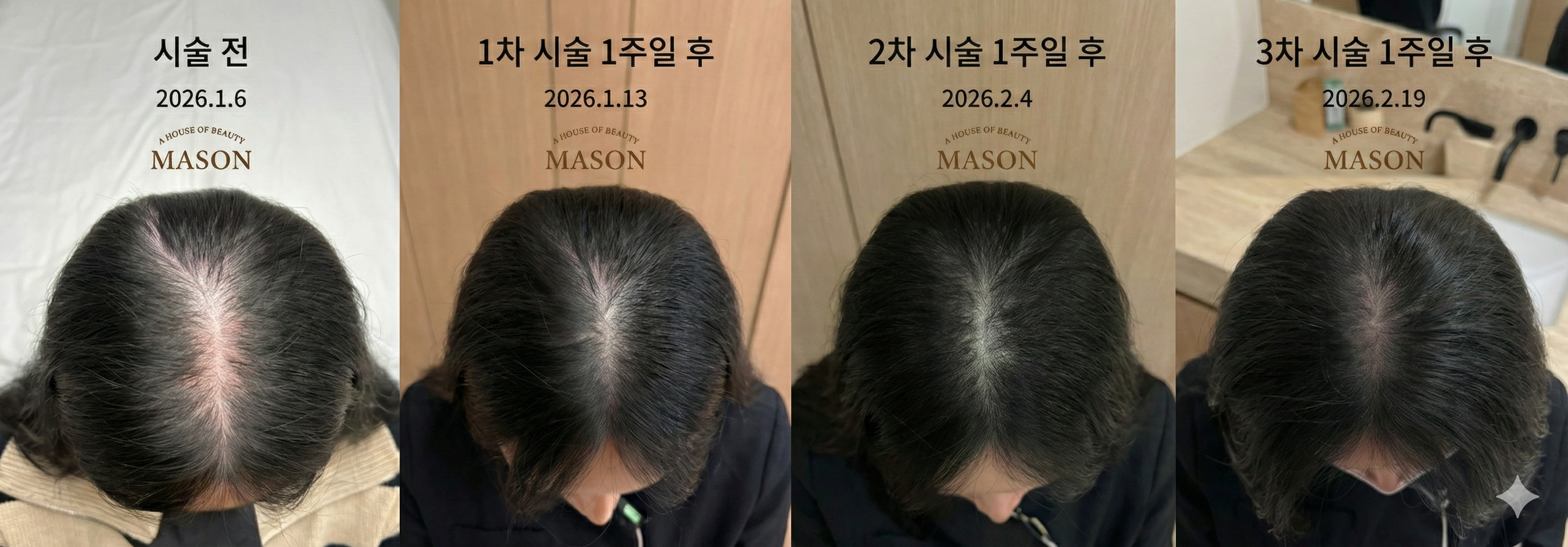 Scalp M-CELL and exosome photo series at Mason Clinic. Mason Clinic, Seoul: Scalp M-CELL and exosome photo series. Clinic-supplied comparison board. January 6 to February 19, 2026