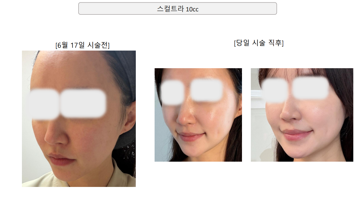 Sculptra — front and angled views at Mason Clinic. Mason Clinic, Seoul: Sculptra — front and angled views. Clinic-supplied comparison board. Immediately after treatment, June 17