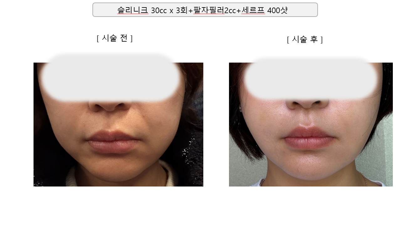 Slinique, nasolabial filler and Shurink at Mason Clinic. Mason Clinic, Seoul: Slinique, nasolabial filler and Shurink. Clinic-supplied comparison board. Follow-up interval not supplied.