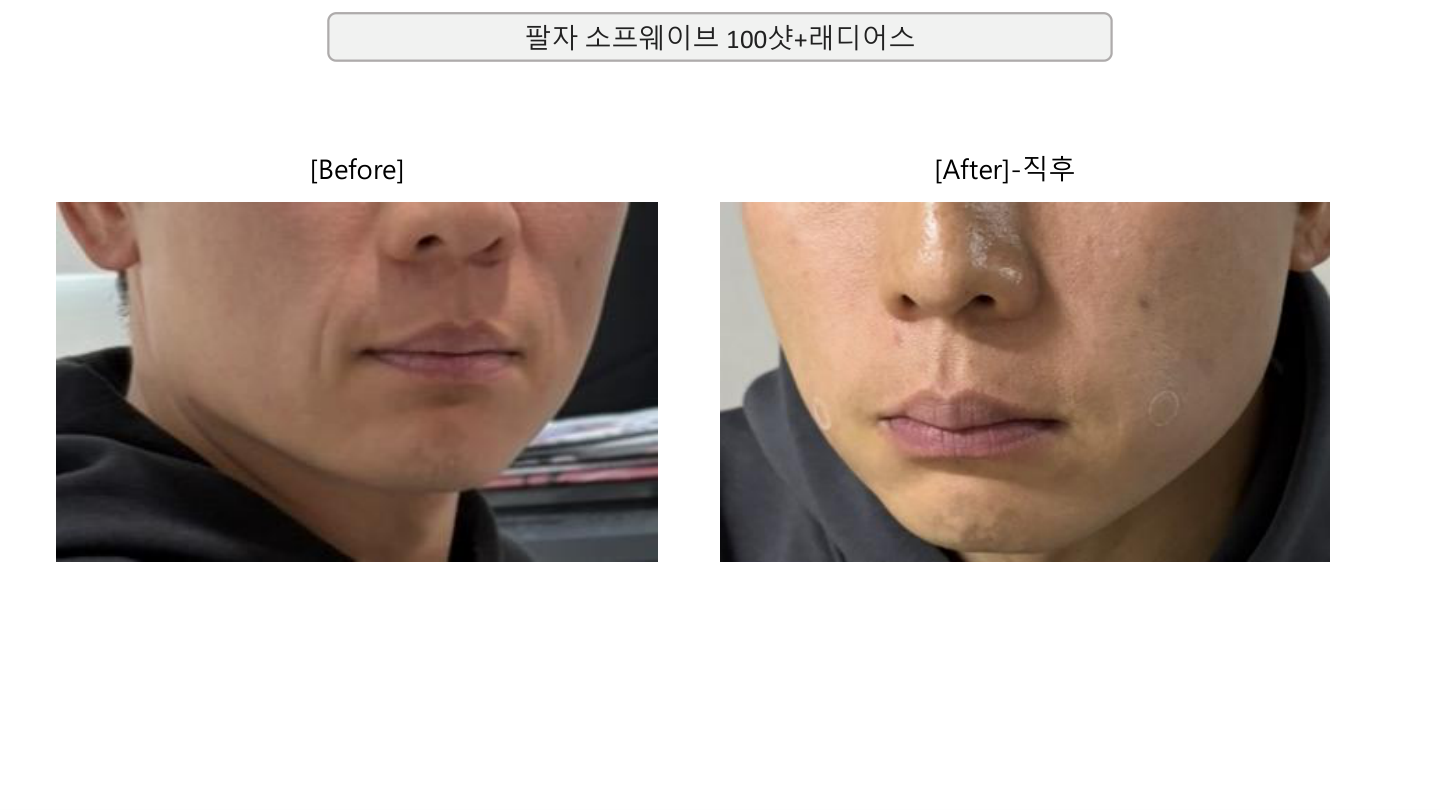 Sofwave 100 shots with Radiesse at Mason Clinic. Mason Clinic, Seoul: Sofwave 100 shots with Radiesse. Clinic document, page 8. Immediately after treatment