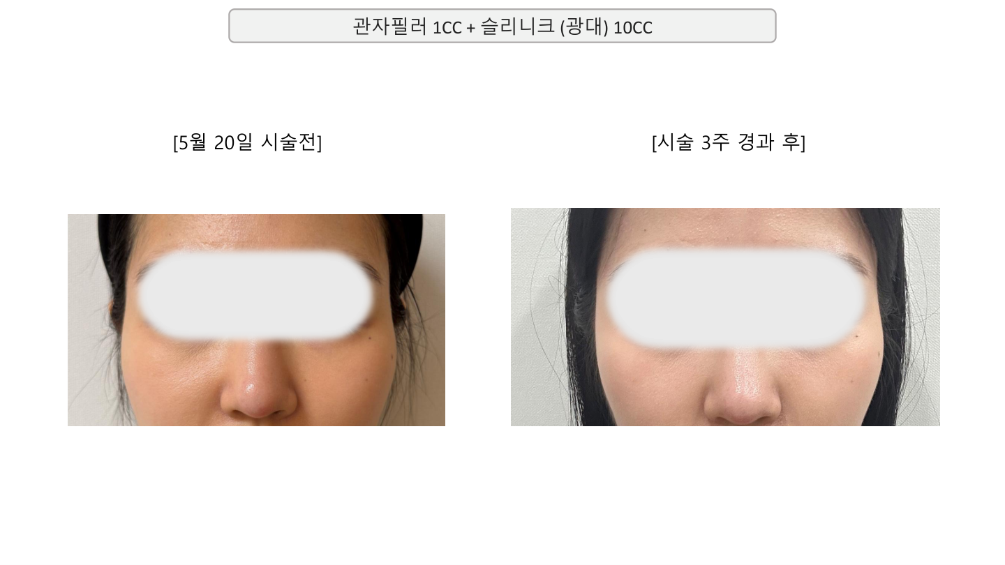 Temple filler with cheek Slinique at Mason Clinic. Mason Clinic, Seoul: Temple filler with cheek Slinique. Clinic document, page 21. Three weeks