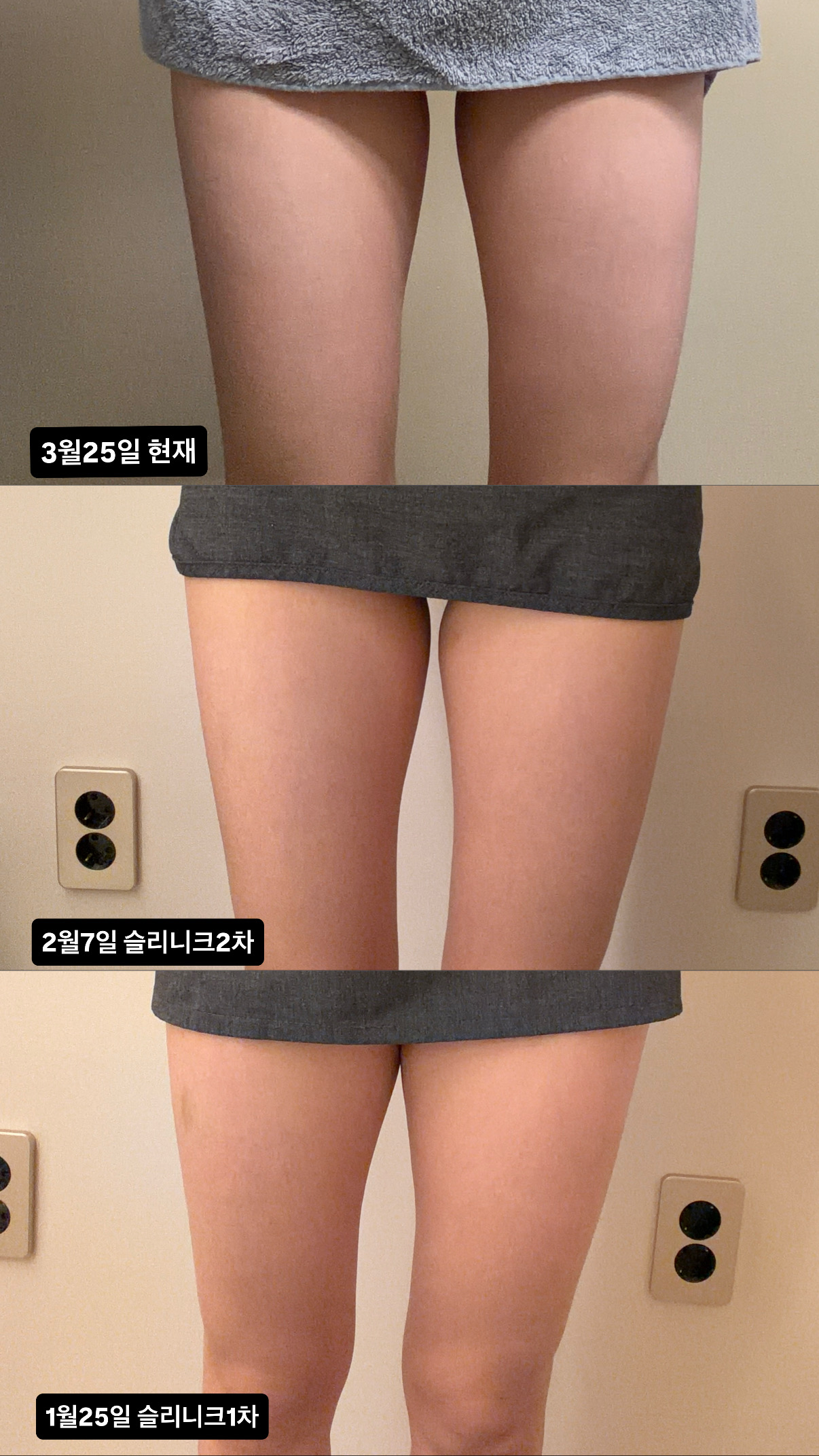 Thigh Slinique — three dated views at Mason Clinic. Mason Clinic, Seoul: Thigh Slinique — three dated views. Clinic-supplied comparison board. January 25, February 27 and March 25