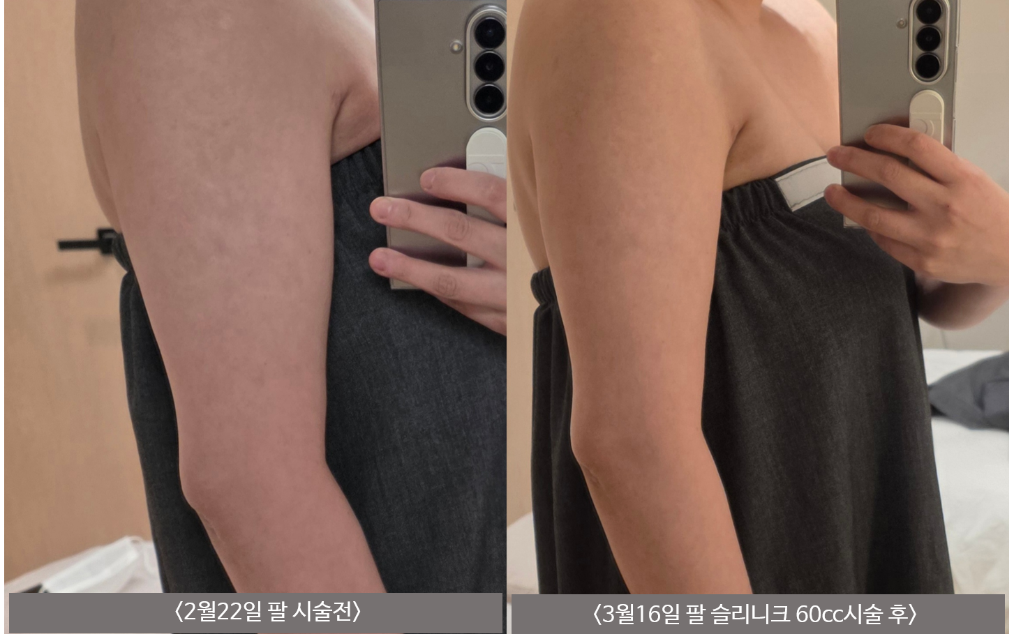 Upper-arm Slinique — 60 cc at Mason Clinic. Mason Clinic, Seoul: Upper-arm Slinique — 60 cc. Clinic-supplied comparison board. February 22 to March 16; year not supplied