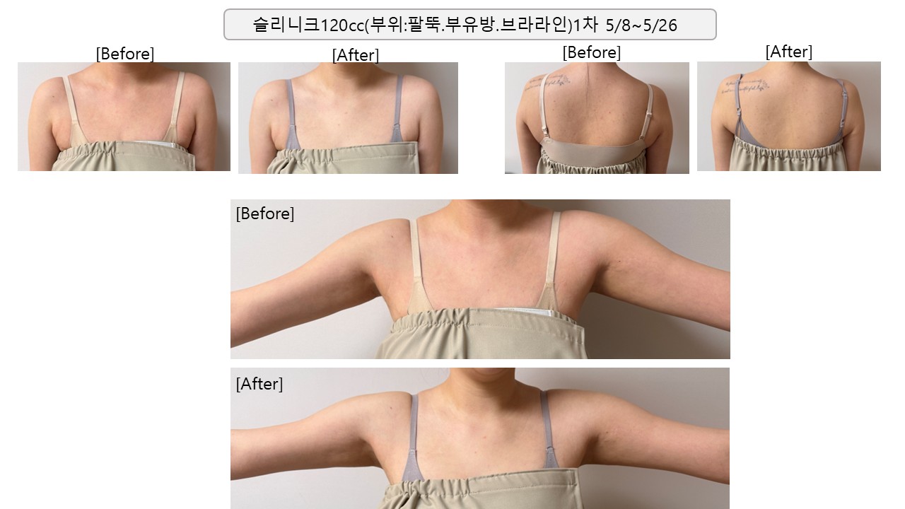 Upper-body Slinique — 120 cc at Mason Clinic. Mason Clinic, Seoul: Upper-body Slinique — 120 cc. Clinic-supplied comparison board. May 8 to May 26; year not supplied