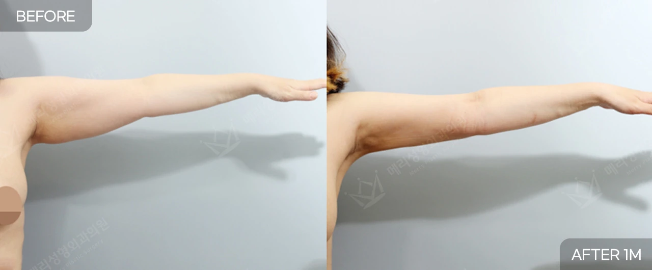 Upper-arm liposuction at Merry Plastic Surgery Clinic. Merry Plastic Surgery, Seoul: upper-arm liposuction — extended upper arm, before and after comparison, 1 month follow-up.