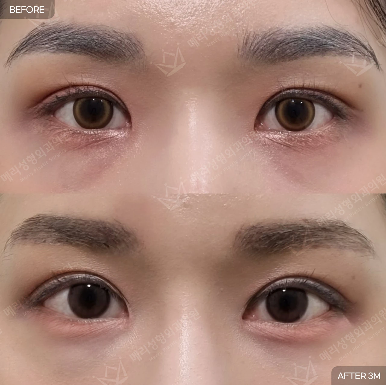 Eyelid surgery: three-month comparison at Merry Plastic Surgery Clinic. Merry Plastic Surgery, Seoul: eyelid surgery — front view with eyes open, before and after comparison, 3 months follow-up.