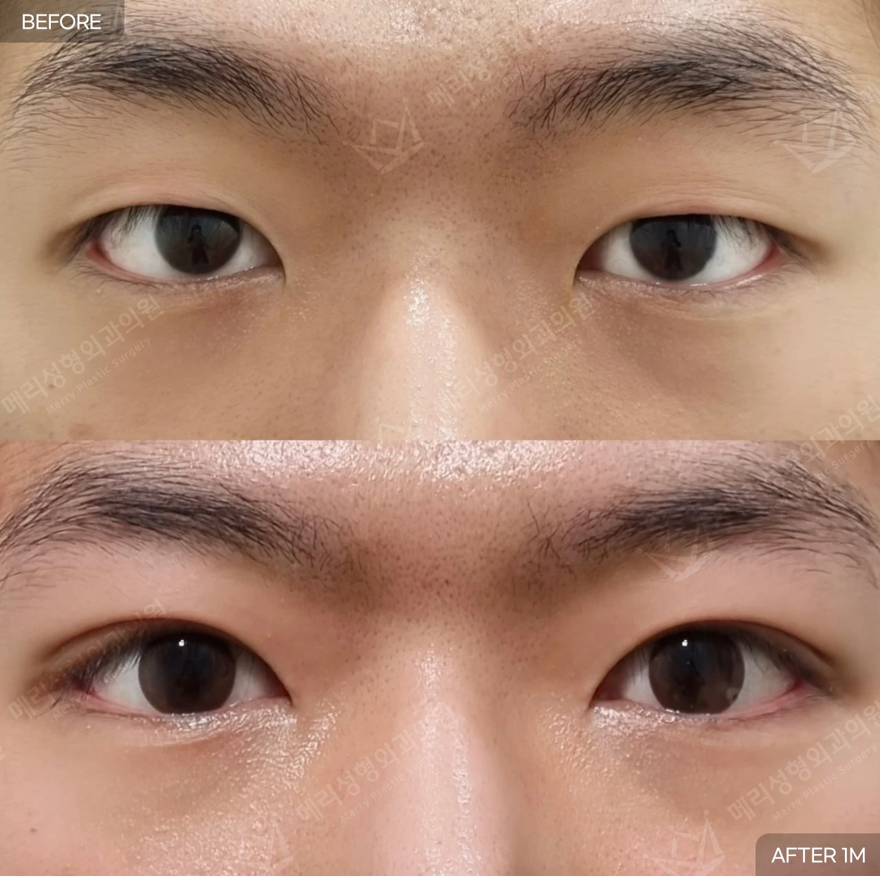 Partial-incision eyelid surgery with ptosis correction at Merry Plastic Surgery Clinic. Merry Plastic Surgery, Seoul: partial-incision eyelid surgery with ptosis correction — front view with eyes open, before and after comparison, 1 month follow-up.