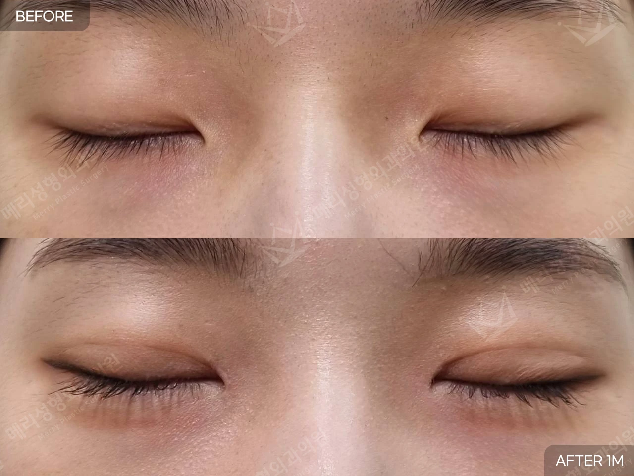 Partial-incision ptosis correction with upper epicanthoplasty at Merry Plastic Surgery Clinic. Merry Plastic Surgery, Seoul: partial-incision ptosis correction with upper epicanthoplasty — front view with eyes closed, before and after comparison, 1 month follow-up.