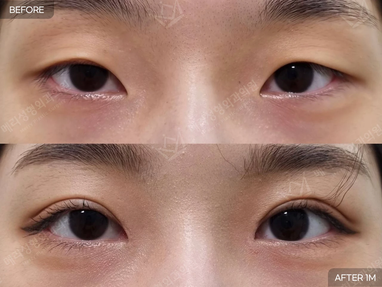 Partial-incision ptosis correction with upper epicanthoplasty at Merry Plastic Surgery Clinic. Merry Plastic Surgery, Seoul: partial-incision ptosis correction with upper epicanthoplasty — front view with eyes open, before and after comparison, 1 month follow-up.