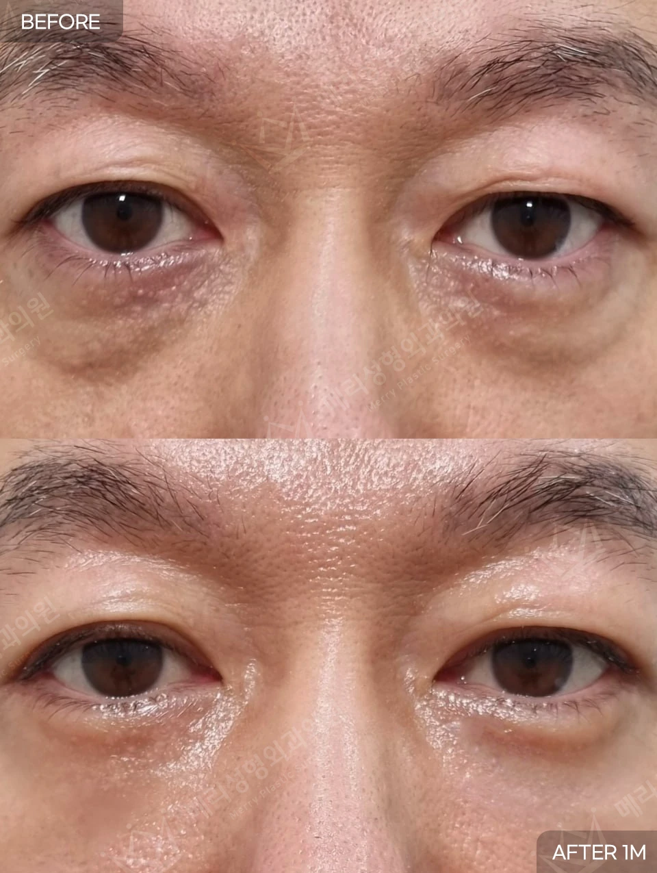 Under-eye fat repositioning with minimal-incision lower blepharoplasty at Merry Plastic Surgery Clinic. Merry Plastic Surgery, Seoul: under-eye fat repositioning with minimal-incision lower blepharoplasty — front view of the lower eyelids, before and after comparison, 1 month follow-up.