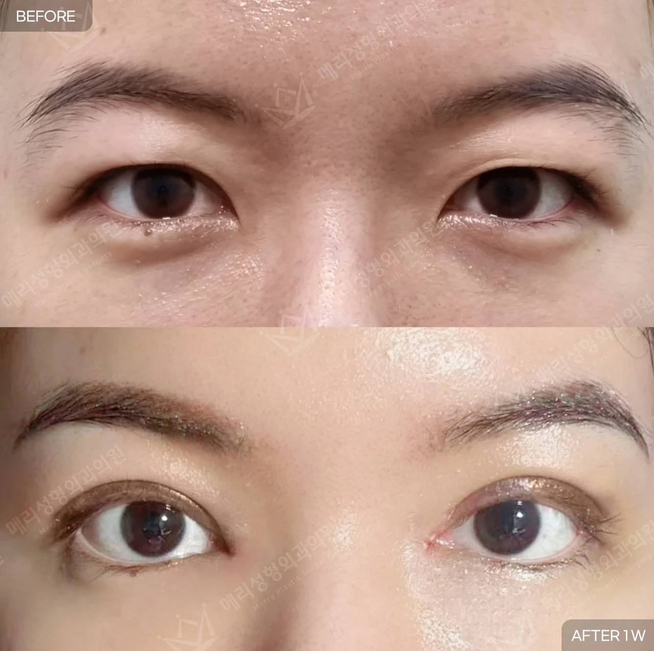 Double-eyelid surgery with upper epicanthoplasty at Merry Plastic Surgery Clinic. Merry Plastic Surgery, Seoul: double-eyelid surgery with upper epicanthoplasty — front view with eyes open, before and after comparison, 1 week follow-up.