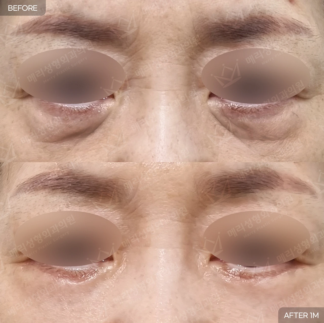 Under-eye fat repositioning at Merry Plastic Surgery Clinic. Merry Plastic Surgery, Seoul: under-eye fat repositioning — front view of the under-eye area, before and after comparison, 1 month follow-up.