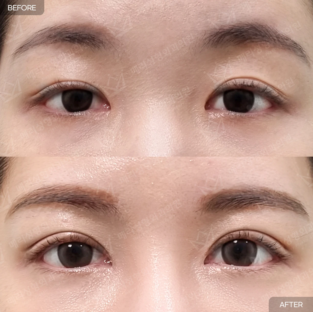 Partial-incision ptosis correction and upper epicanthoplasty at Merry Plastic Surgery Clinic. Merry Plastic Surgery, Seoul: partial-incision ptosis correction and upper epicanthoplasty — front view with eyes open, before and after comparison.