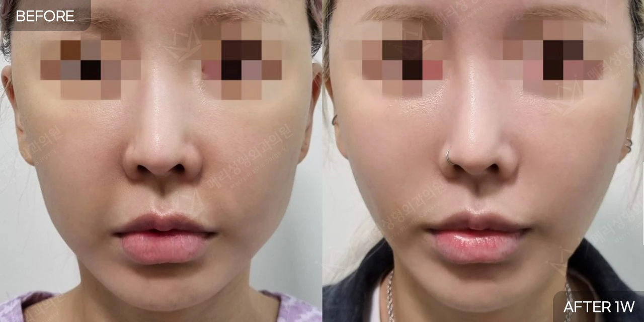 Thread lifting: one-week comparison at Merry Plastic Surgery Clinic. Merry Plastic Surgery, Seoul: thread lifting — front view of the cheeks and jawline, before and after comparison, 1 week follow-up.