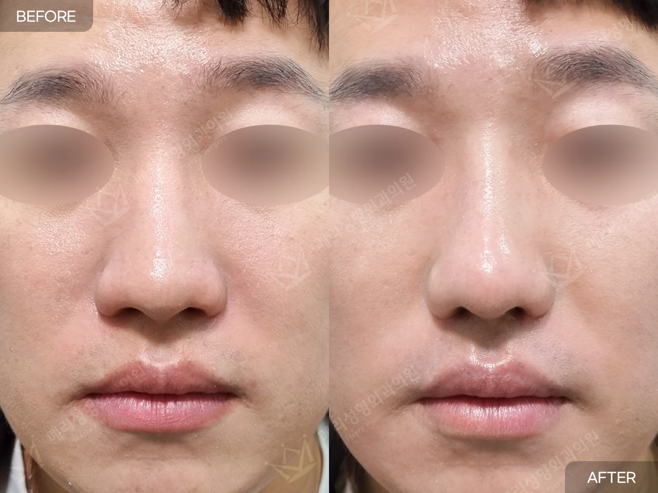 Functional rhinoplasty and nasal hump correction at Merry Plastic Surgery Clinic. Merry Plastic Surgery, Seoul: functional rhinoplasty and nasal hump correction — front view, before and after comparison.