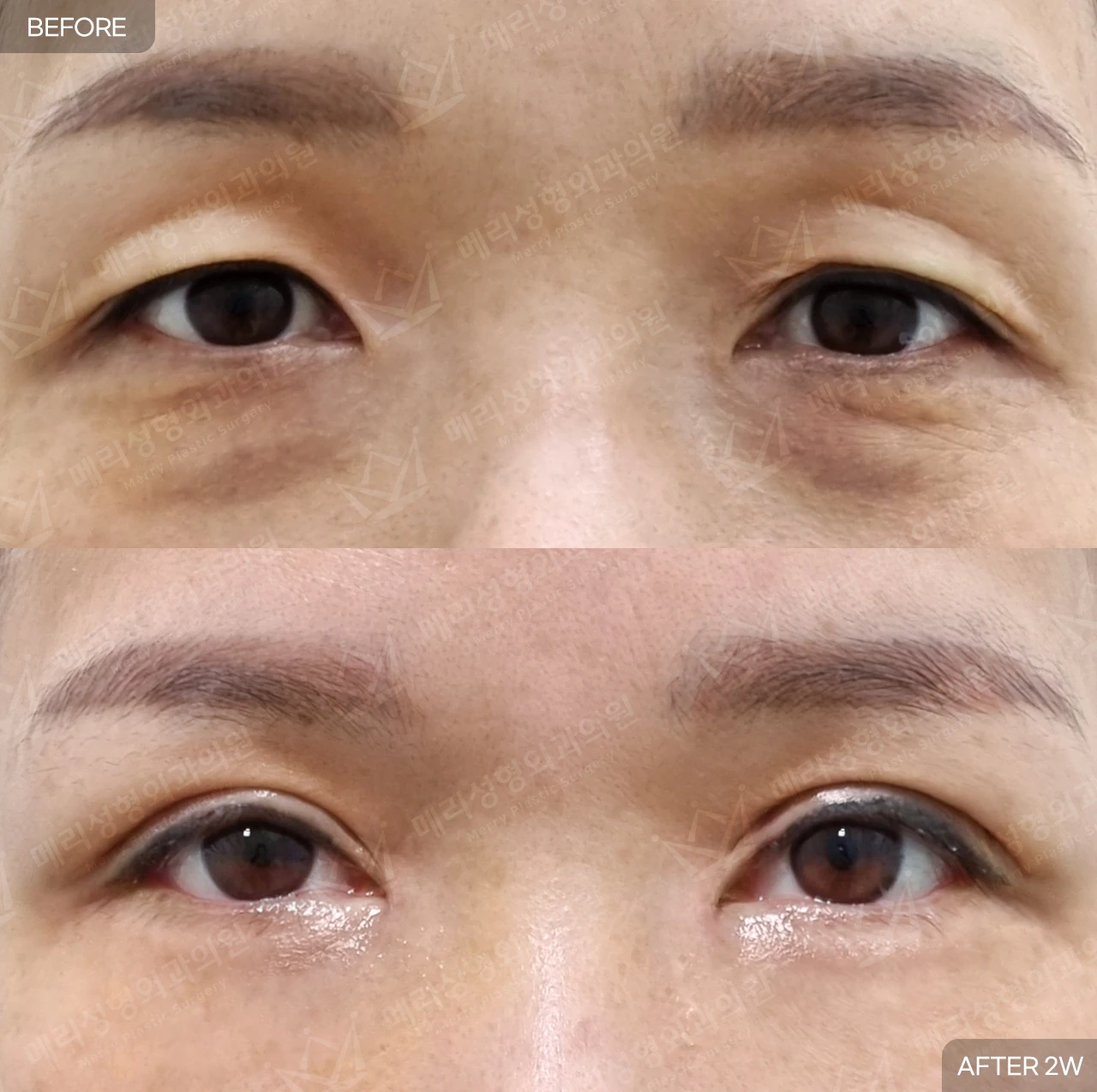 Upper eyelid surgery, ptosis correction and under-eye fat repositioning at Merry Plastic Surgery Clinic. Merry Plastic Surgery, Seoul: upper eyelid surgery, ptosis correction and under-eye fat repositioning — front view of the upper and lower eyelids, before and after comparison, 2 weeks follow-up.