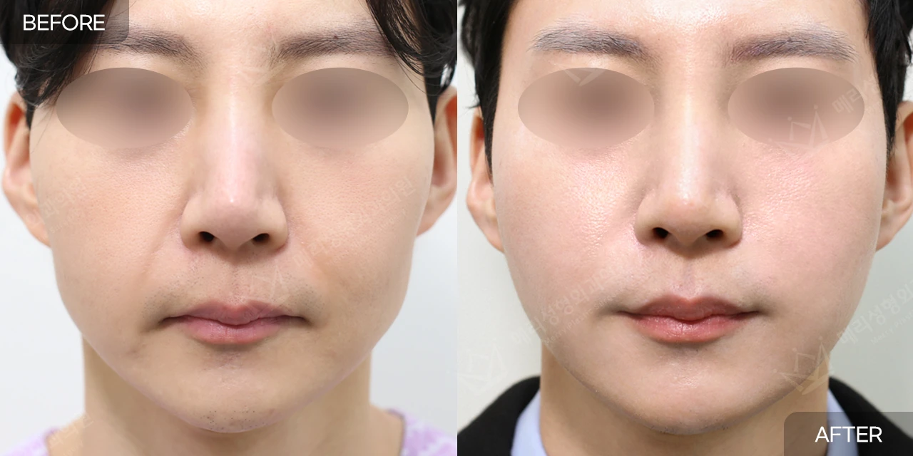 Thread lifting with filler at Merry Plastic Surgery Clinic. Merry Plastic Surgery, Seoul: thread lifting with filler — front view of the cheeks and jawline, before and after comparison.