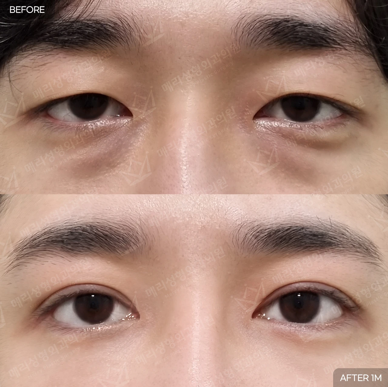 Partial-incision ptosis correction and under-eye fat repositioning at Merry Plastic Surgery Clinic. Merry Plastic Surgery, Seoul: partial-incision ptosis correction and under-eye fat repositioning — front view of the upper and lower eyelids, before and after comparison, 1 month follow-up.