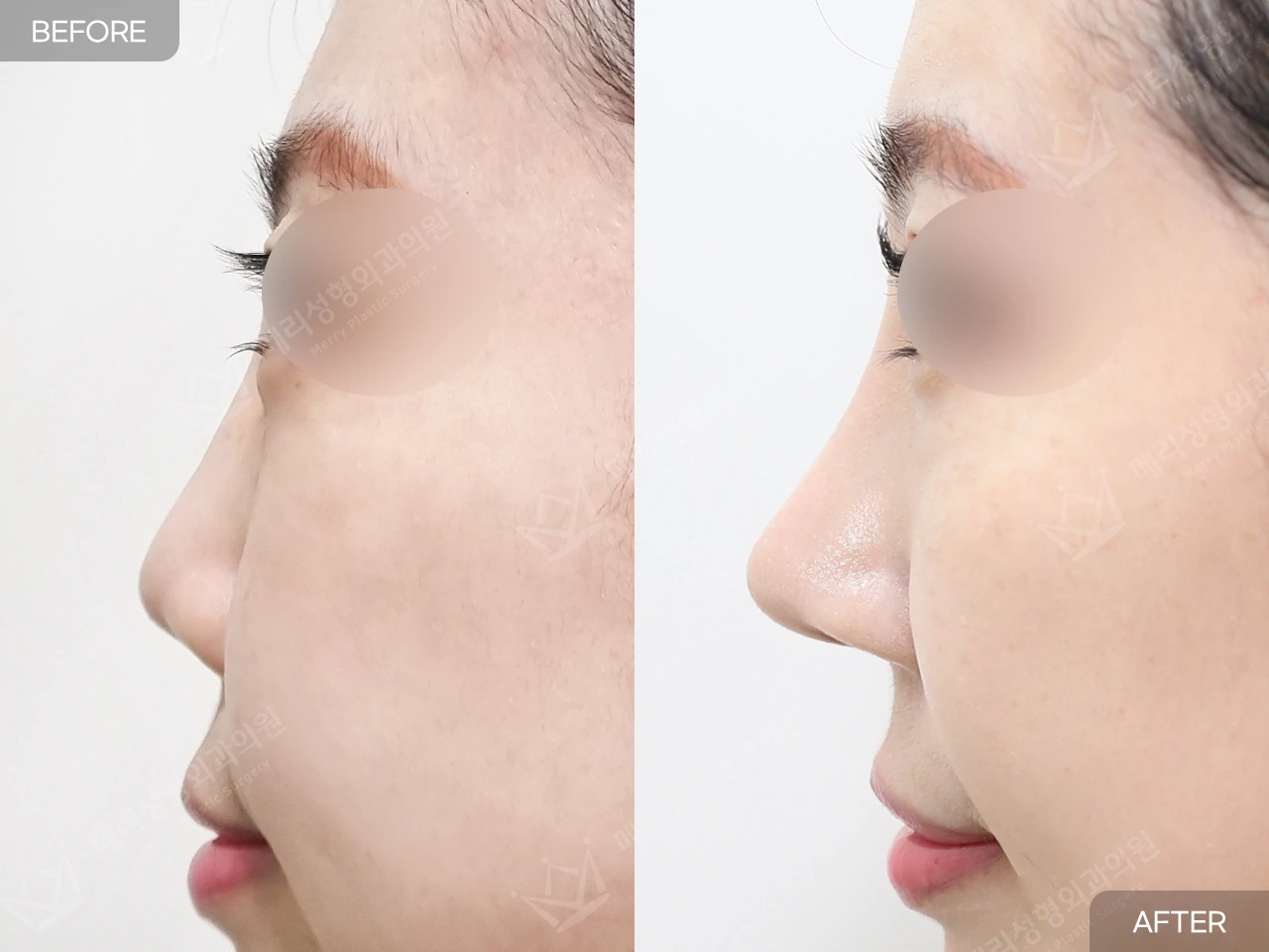Short-nose correction with rhinoplasty at Merry Plastic Surgery Clinic. Merry Plastic Surgery, Seoul: short-nose correction with rhinoplasty — side profile, before and after comparison.