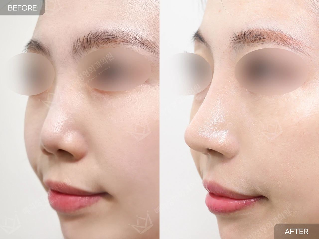 Short-nose correction with rhinoplasty at Merry Plastic Surgery Clinic. Merry Plastic Surgery, Seoul: short-nose correction with rhinoplasty — oblique view, before and after comparison.