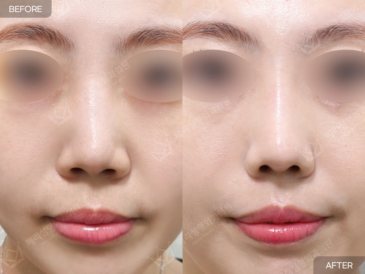 Short-nose correction with rhinoplasty at Merry Plastic Surgery Clinic. Merry Plastic Surgery, Seoul: short-nose correction with rhinoplasty — front view, before and after comparison.