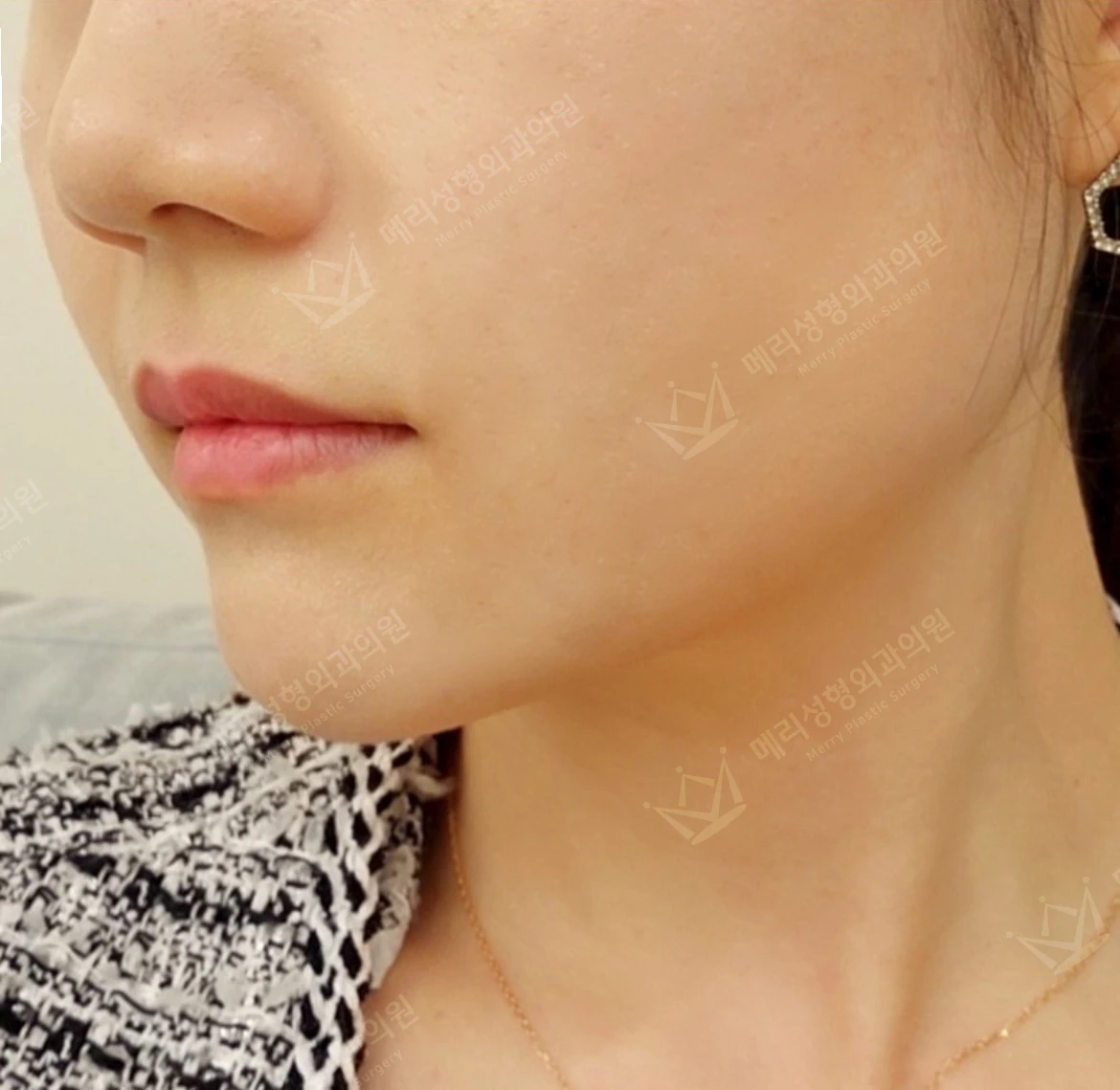 Liftera 2 lifting: cheek and jawline comparison at Merry Plastic Surgery Clinic. Merry Plastic Surgery, Seoul: liftera 2 lifting — oblique view of the cheek and jawline, after treatment.
