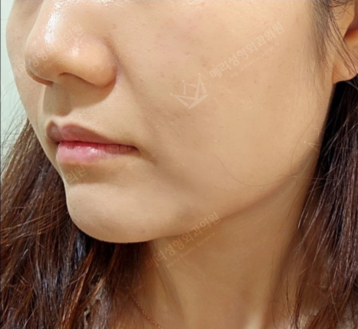 Liftera 2 lifting: cheek and jawline comparison at Merry Plastic Surgery Clinic. Merry Plastic Surgery, Seoul: liftera 2 lifting — oblique view of the cheek and jawline, before treatment.