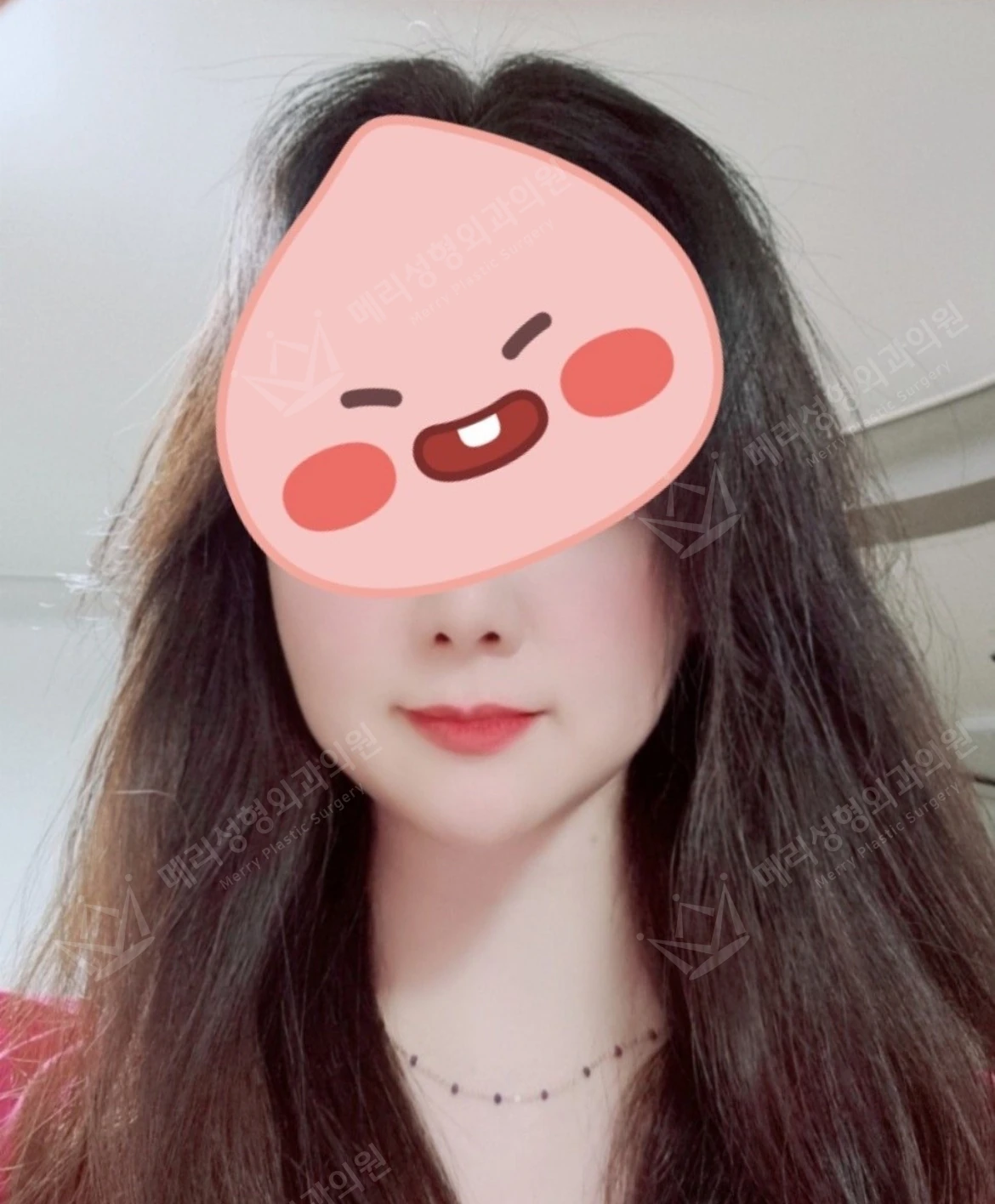 Liftera 2 lifting: lower-face photographs at Merry Plastic Surgery Clinic. Merry Plastic Surgery, Seoul: liftera 2 lifting — front-facing lower-face view, before treatment.