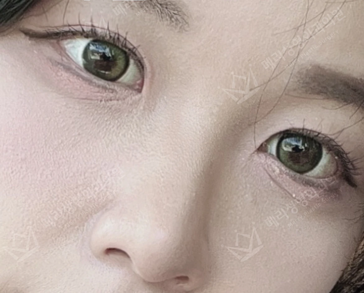 Revision eyelid surgery and revision rhinoplasty at Merry Plastic Surgery Clinic. Merry Plastic Surgery, Seoul: revision eyelid surgery and revision rhinoplasty — close-up oblique view of the eyelids and nose, before treatment.