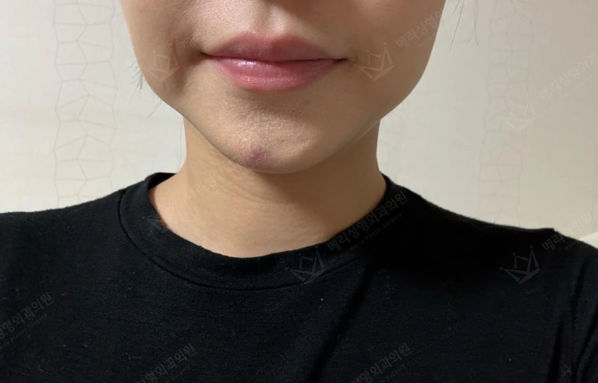 Liftera 2 lifting with botulinum toxin at Merry Plastic Surgery Clinic. Merry Plastic Surgery, Seoul: liftera 2 lifting with botulinum toxin — front view of the lower face, before treatment.