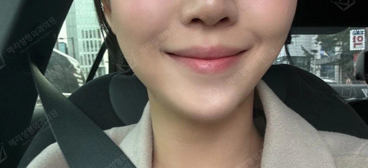 Liftera 2 lifting with botulinum toxin at Merry Plastic Surgery Clinic. Merry Plastic Surgery, Seoul: liftera 2 lifting with botulinum toxin — front view of the lower face, after treatment.