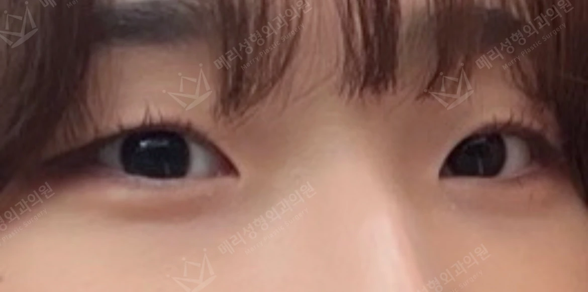 Non-incisional double-eyelid surgery with upper epicanthoplasty at Merry Plastic Surgery Clinic. Merry Plastic Surgery, Seoul: non-incisional double-eyelid surgery with upper epicanthoplasty — close-up of the eyelid creases and inner corners, before treatment.