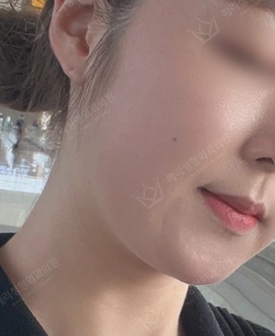 Liftera 2 lifting: oblique facial photographs at Merry Plastic Surgery Clinic. Merry Plastic Surgery, Seoul: liftera 2 lifting — oblique view of the cheek and jawline, before treatment.