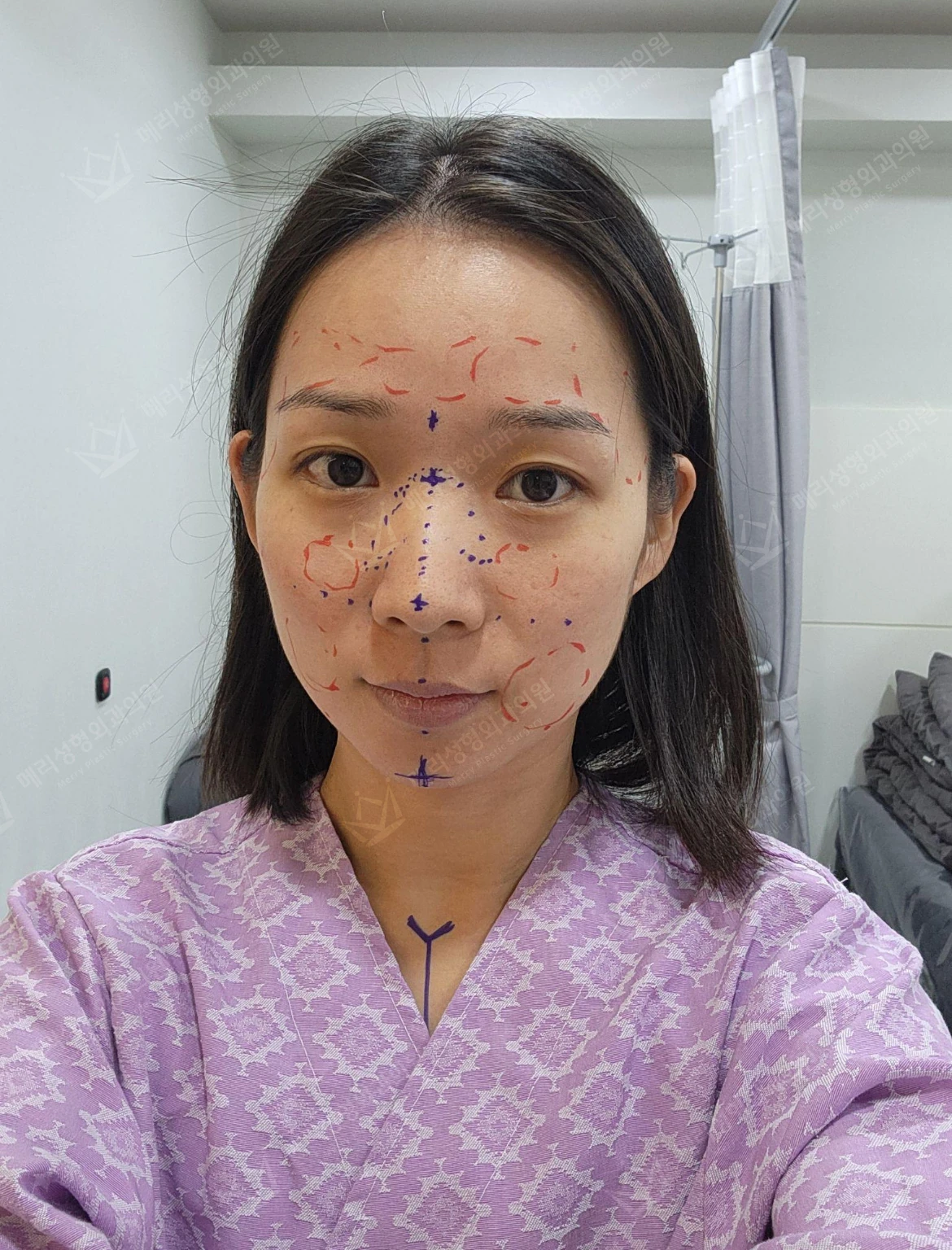 Rhinoplasty, thread lifting and facial fat grafting at Merry Plastic Surgery Clinic. Merry Plastic Surgery, Seoul: rhinoplasty, thread lifting and facial fat grafting, before treatment, front view with surgical planning marks.