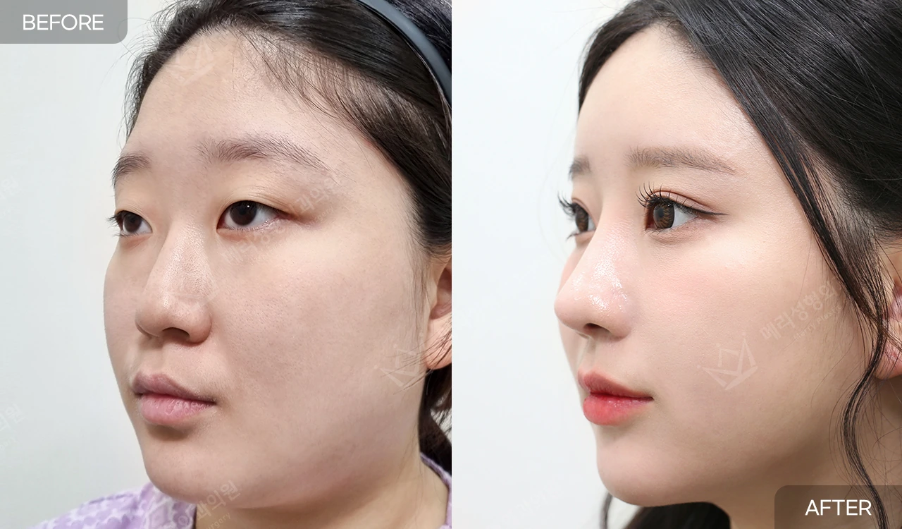 Eyelid and nose surgery with forehead fat grafting and chin liposuction at Merry Plastic Surgery Clinic. Merry Plastic Surgery, Seoul: eyelid and nose surgery with forehead fat grafting and chin liposuction, before and after; interval not supplied, oblique view.