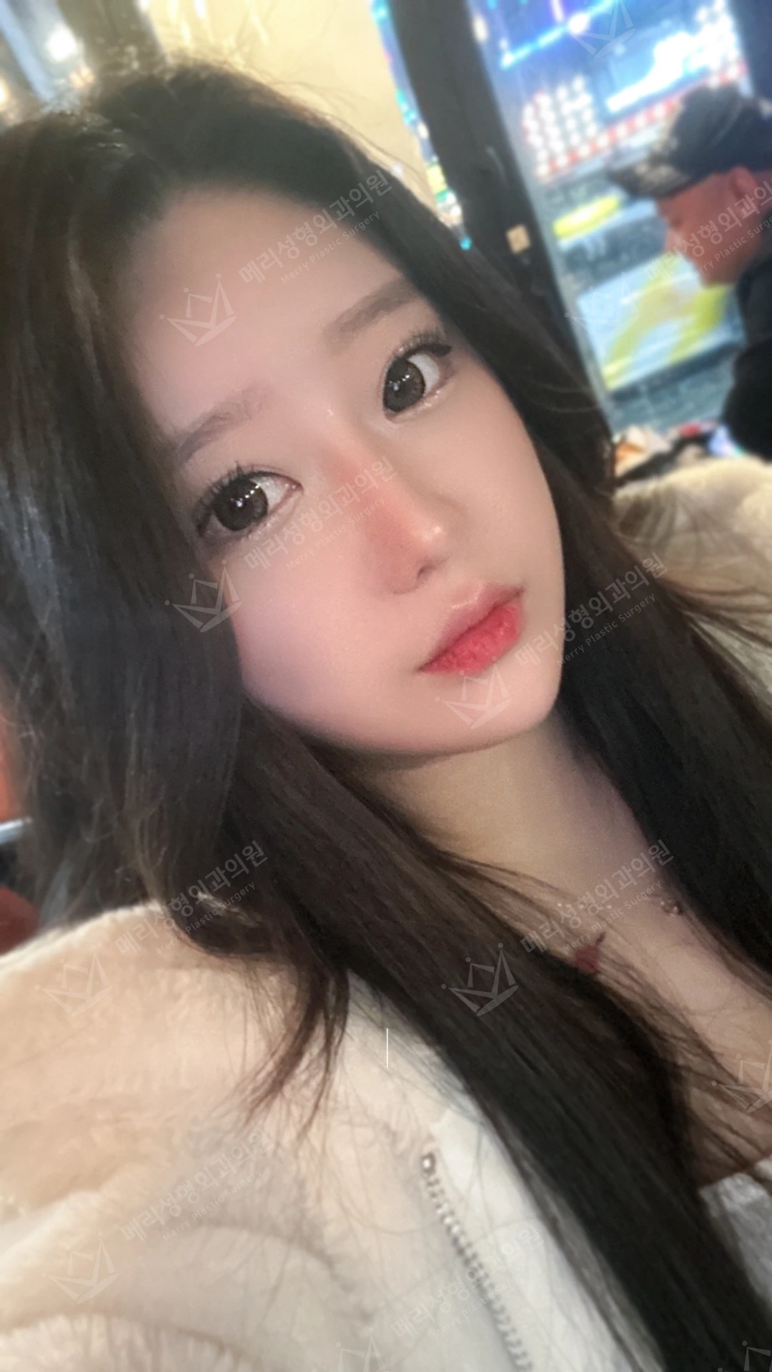 Eyelid and nose surgery with forehead fat grafting and chin liposuction at Merry Plastic Surgery Clinic. Merry Plastic Surgery, Seoul: eyelid and nose surgery with forehead fat grafting and chin liposuction, one month after surgery, photograph.