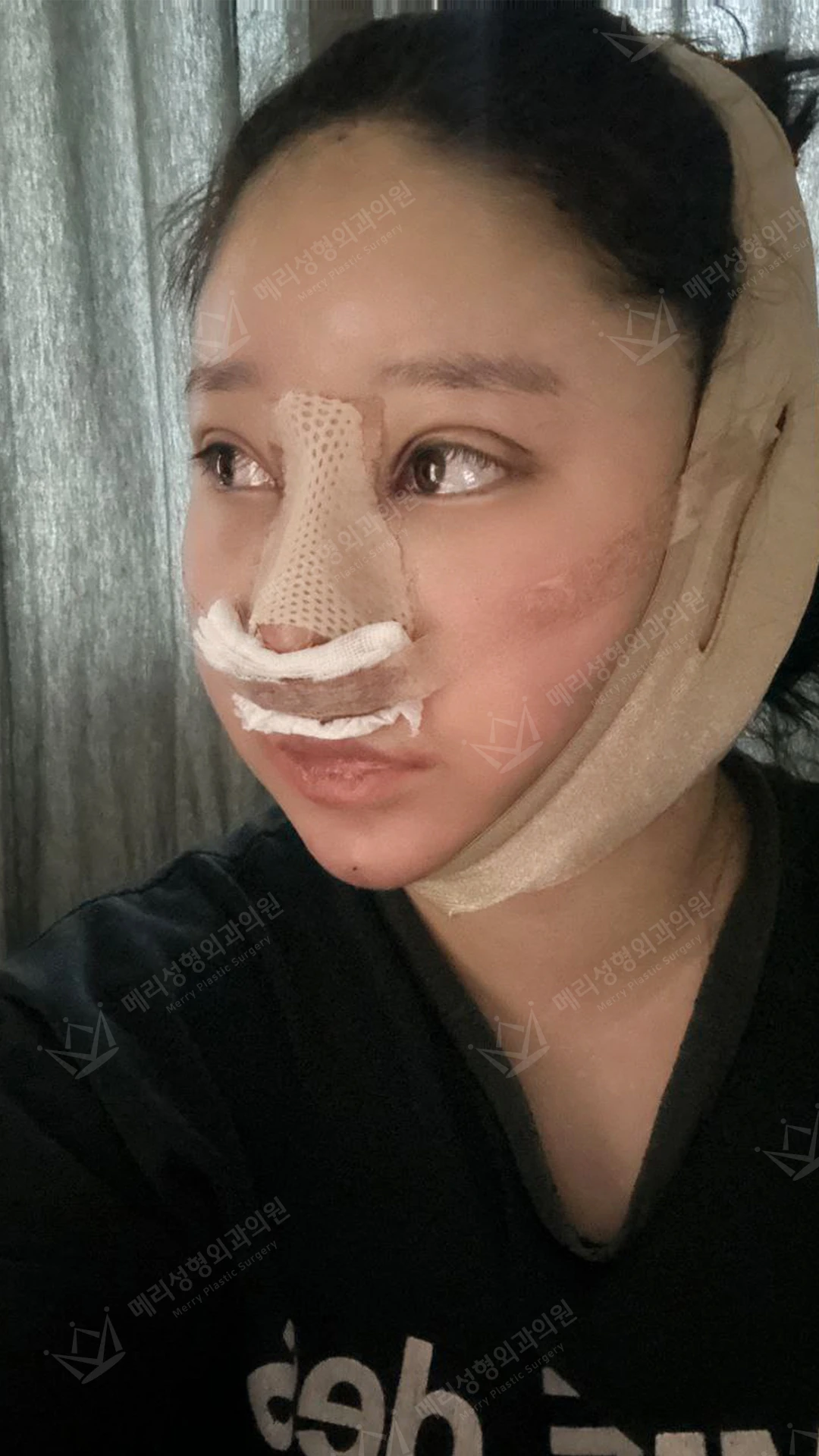 Eyelid and nose surgery with forehead fat grafting and chin liposuction at Merry Plastic Surgery Clinic. Merry Plastic Surgery, Seoul: eyelid and nose surgery with forehead fat grafting and chin liposuction, surgery day, photograph.