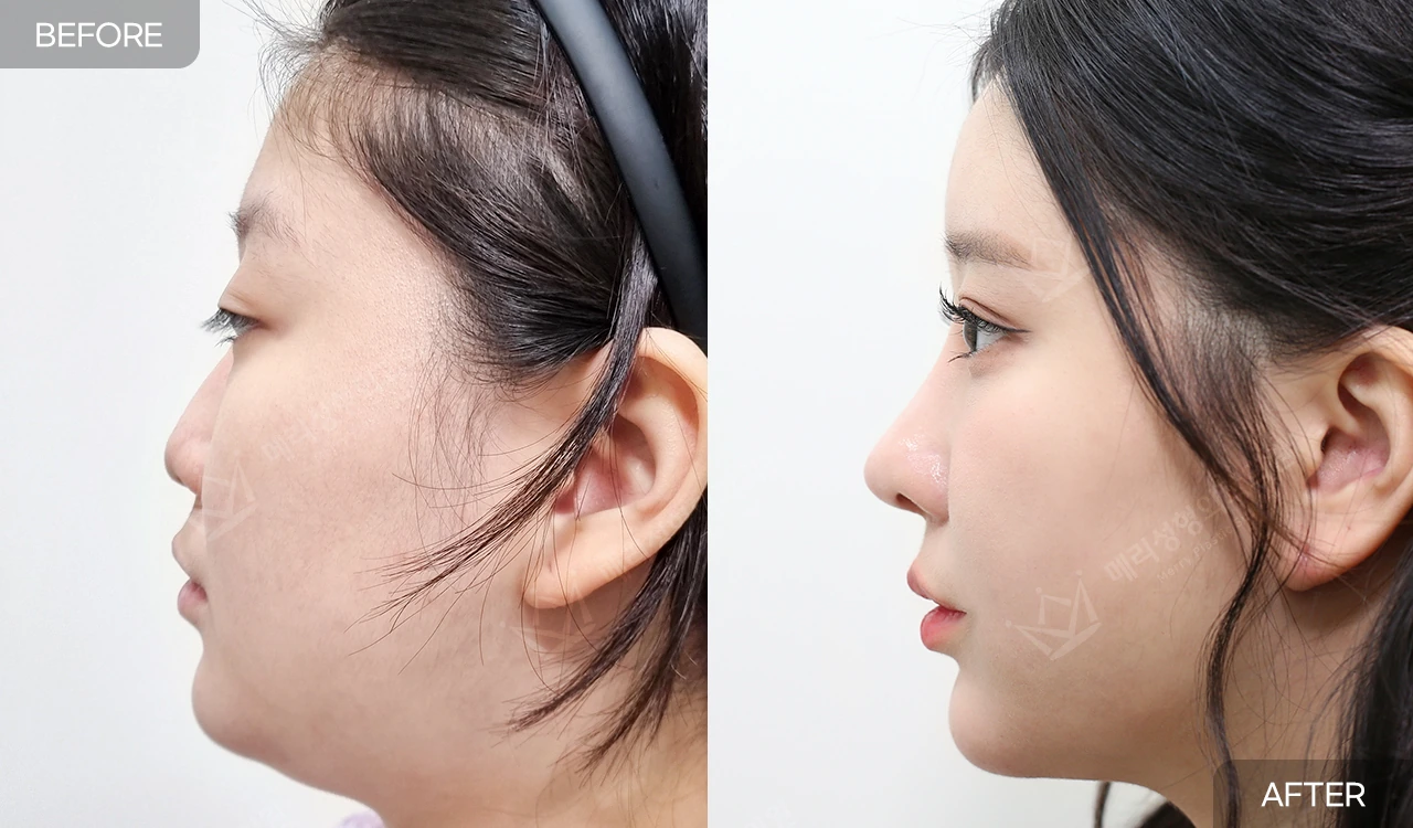 Eyelid and nose surgery with forehead fat grafting and chin liposuction at Merry Plastic Surgery Clinic. Merry Plastic Surgery, Seoul: eyelid and nose surgery with forehead fat grafting and chin liposuction, before and after; interval not supplied, side profile.