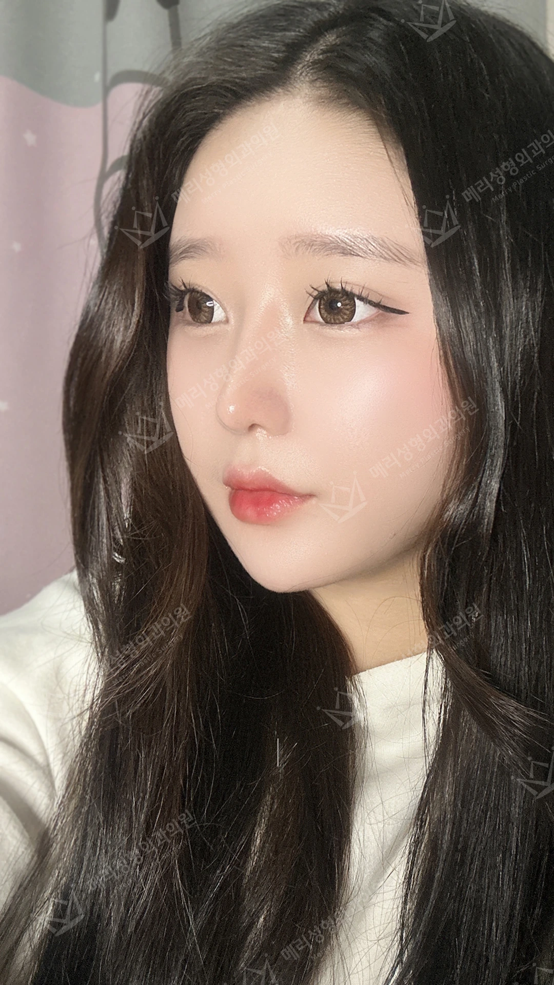 Eyelid and nose surgery with forehead fat grafting and chin liposuction at Merry Plastic Surgery Clinic. Merry Plastic Surgery, Seoul: eyelid and nose surgery with forehead fat grafting and chin liposuction, three months after surgery, photograph.