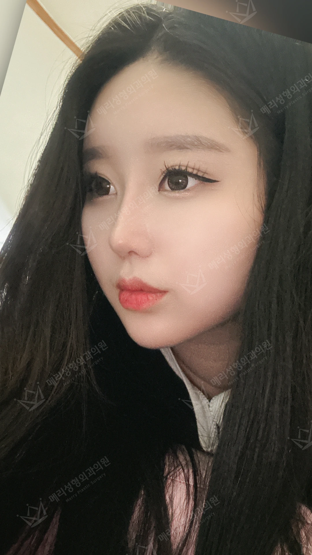 Eyelid and nose surgery with forehead fat grafting and chin liposuction at Merry Plastic Surgery Clinic. Merry Plastic Surgery, Seoul: eyelid and nose surgery with forehead fat grafting and chin liposuction, one month after surgery, photograph.