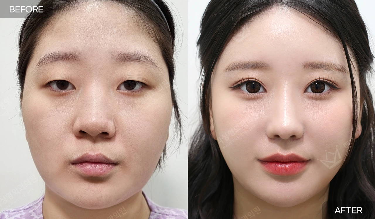 Eyelid and nose surgery with forehead fat grafting and chin liposuction at Merry Plastic Surgery Clinic. Merry Plastic Surgery, Seoul: eyelid and nose surgery with forehead fat grafting and chin liposuction, before and after; interval not supplied, front view.
