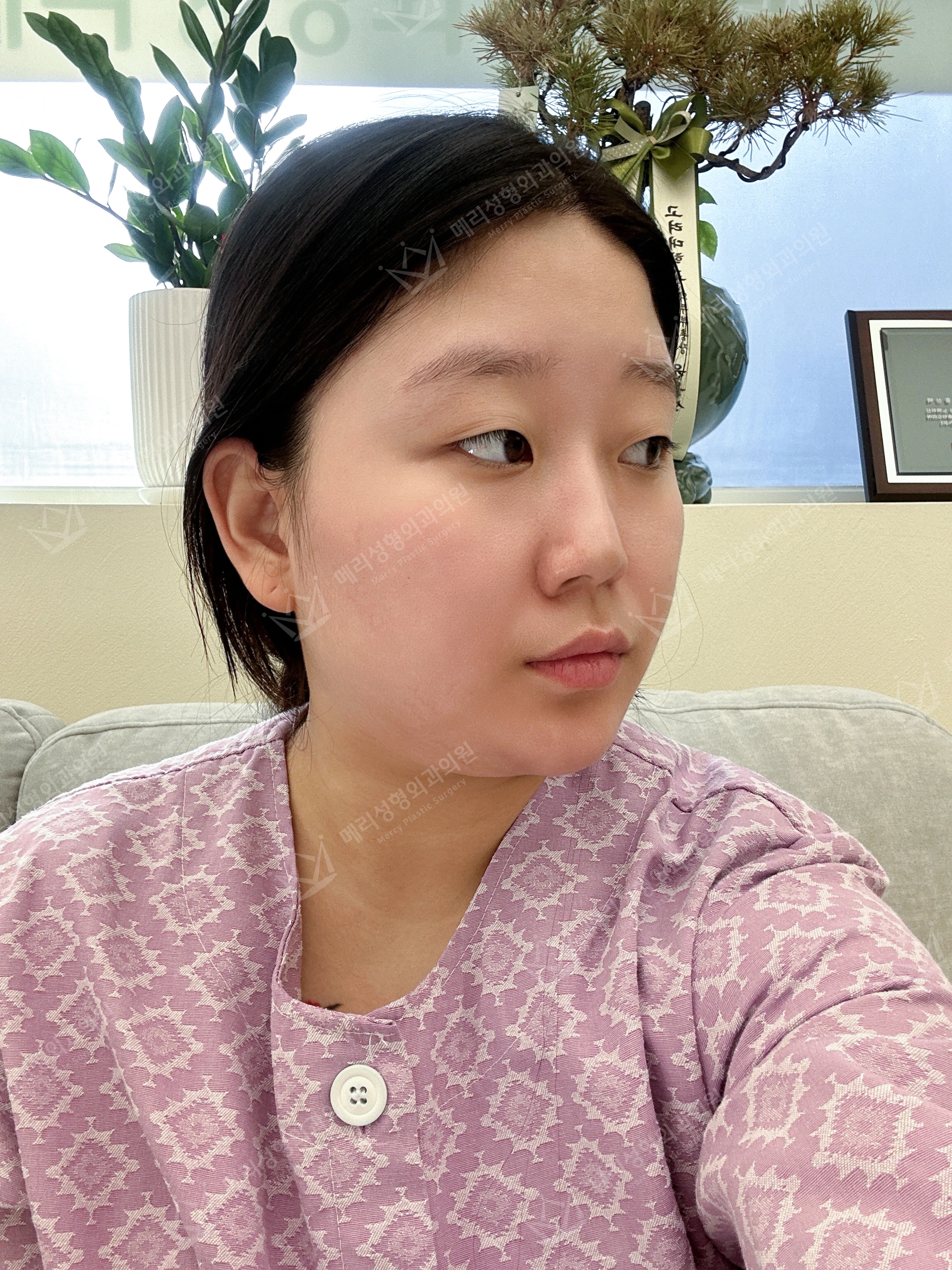 Eyelid and nose surgery with forehead fat grafting and chin liposuction at Merry Plastic Surgery Clinic. Merry Plastic Surgery, Seoul: eyelid and nose surgery with forehead fat grafting and chin liposuction, before treatment, photograph.