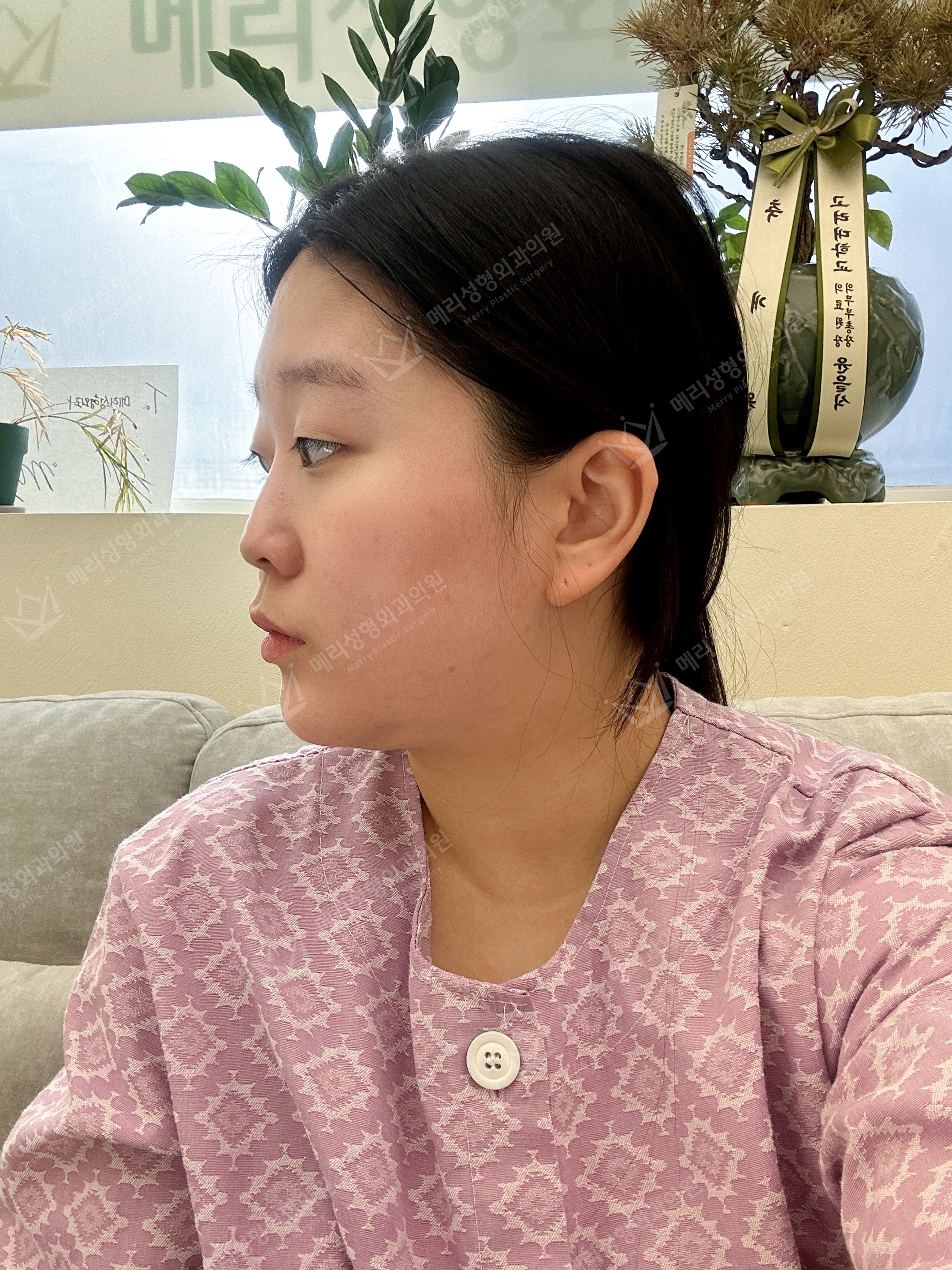 Eyelid and nose surgery with forehead fat grafting and chin liposuction at Merry Plastic Surgery Clinic. Merry Plastic Surgery, Seoul: eyelid and nose surgery with forehead fat grafting and chin liposuction, before treatment, photograph.