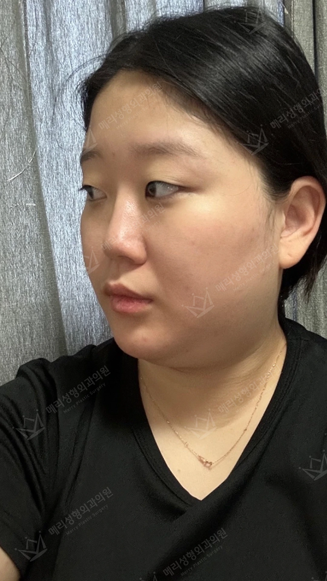 Eyelid and nose surgery with forehead fat grafting and chin liposuction at Merry Plastic Surgery Clinic. Merry Plastic Surgery, Seoul: eyelid and nose surgery with forehead fat grafting and chin liposuction, before treatment, photograph.