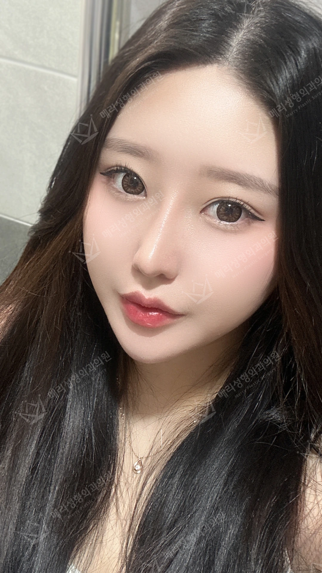 Eyelid and nose surgery with forehead fat grafting and chin liposuction at Merry Plastic Surgery Clinic. Merry Plastic Surgery, Seoul: eyelid and nose surgery with forehead fat grafting and chin liposuction, three months after surgery, photograph.