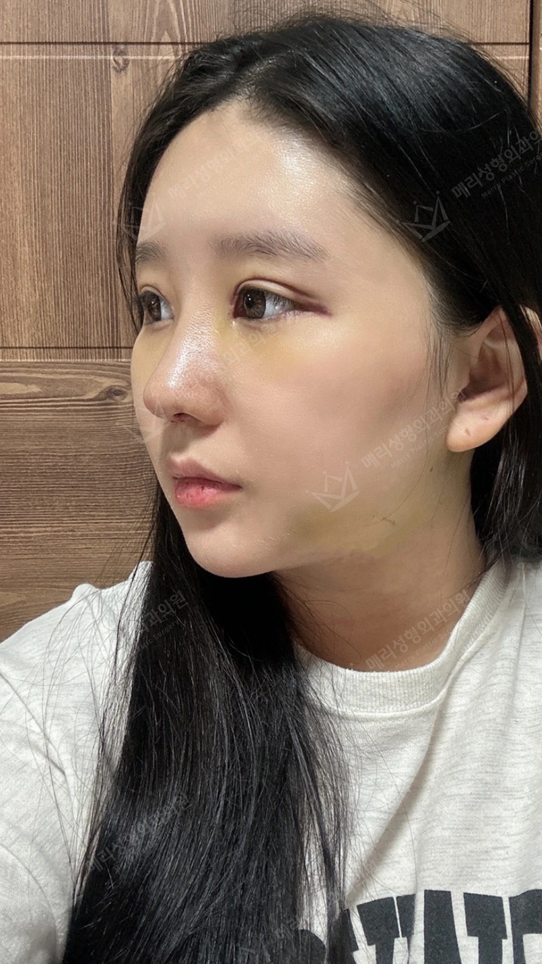 Eyelid and nose surgery with forehead fat grafting and chin liposuction at Merry Plastic Surgery Clinic. Merry Plastic Surgery, Seoul: eyelid and nose surgery with forehead fat grafting and chin liposuction, one week after surgery, photograph.
