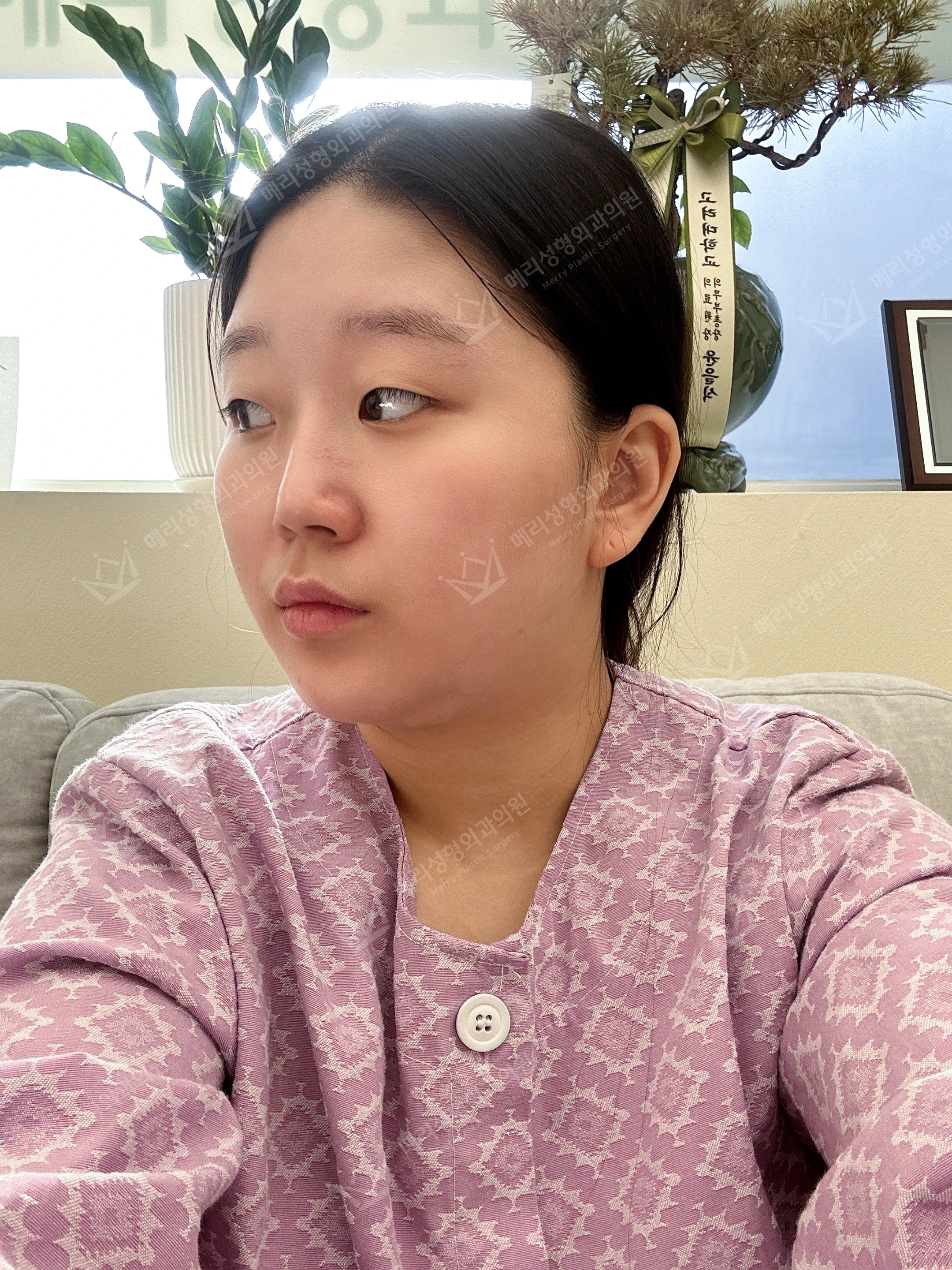 Eyelid and nose surgery with forehead fat grafting and chin liposuction at Merry Plastic Surgery Clinic. Merry Plastic Surgery, Seoul: eyelid and nose surgery with forehead fat grafting and chin liposuction, before treatment, photograph.
