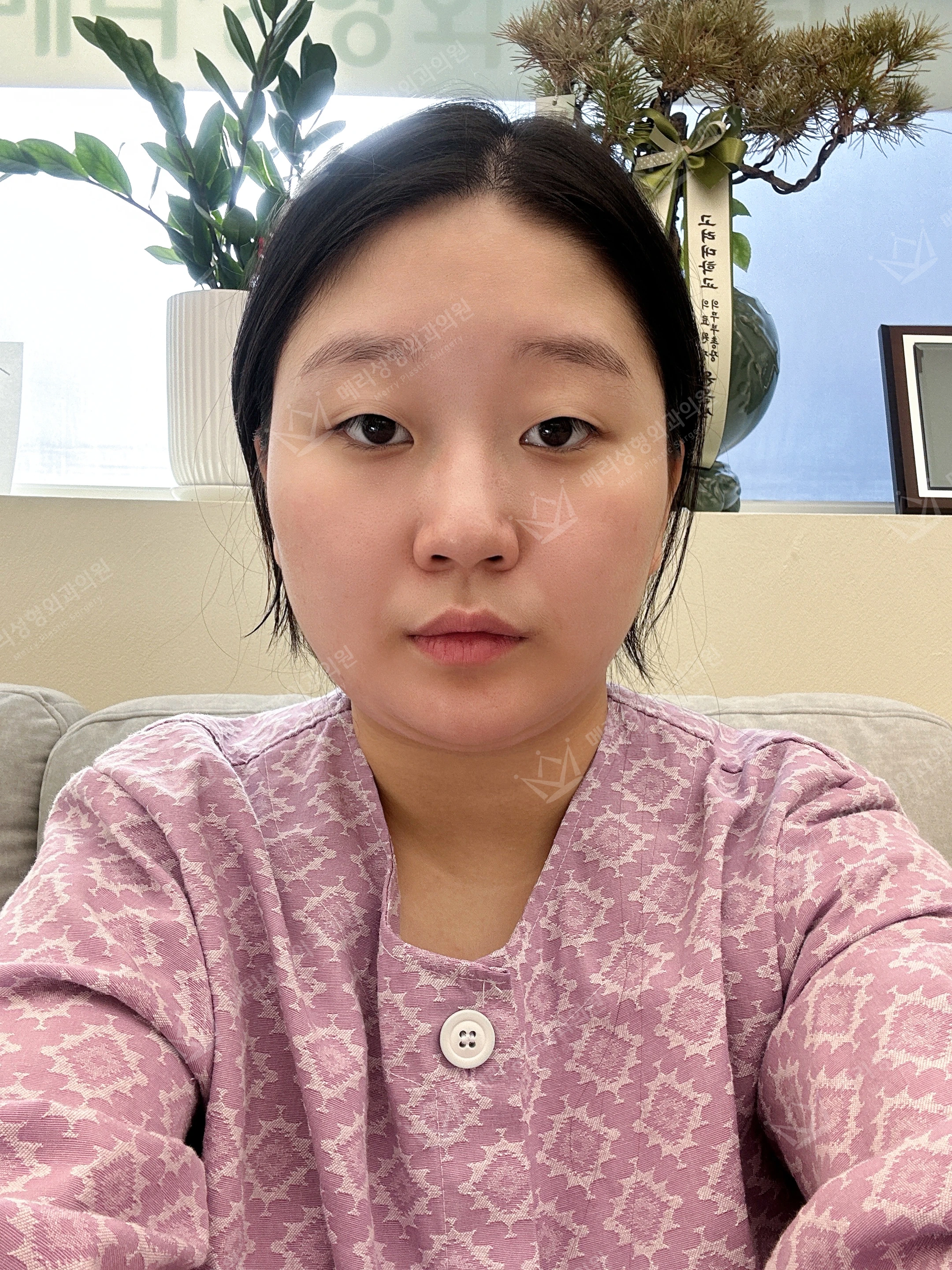 Eyelid and nose surgery with forehead fat grafting and chin liposuction at Merry Plastic Surgery Clinic. Merry Plastic Surgery, Seoul: eyelid and nose surgery with forehead fat grafting and chin liposuction, before treatment, photograph.